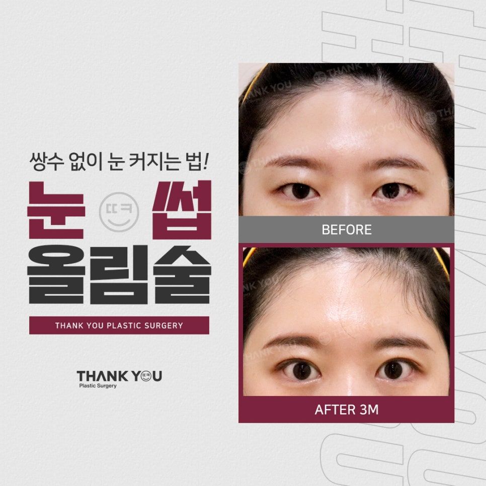 엔도타인 이마거상 찾는다면?시니어&주니어 눈썹올림술 관련 이미지 1