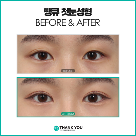 What Should You Check for First-Time Eye Surgery to Achieve Natural and Beautiful Eyes? image 9