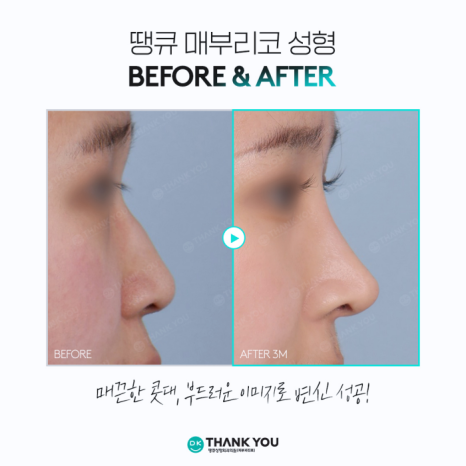 Hump Nose Improvement: Personalized Surgery Is Important! image 9