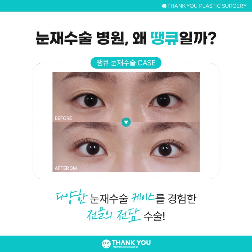 눈재수술병원 잘 고르려면?! 맞춤 수술 여부가 핵심👍 관련 이미지 8