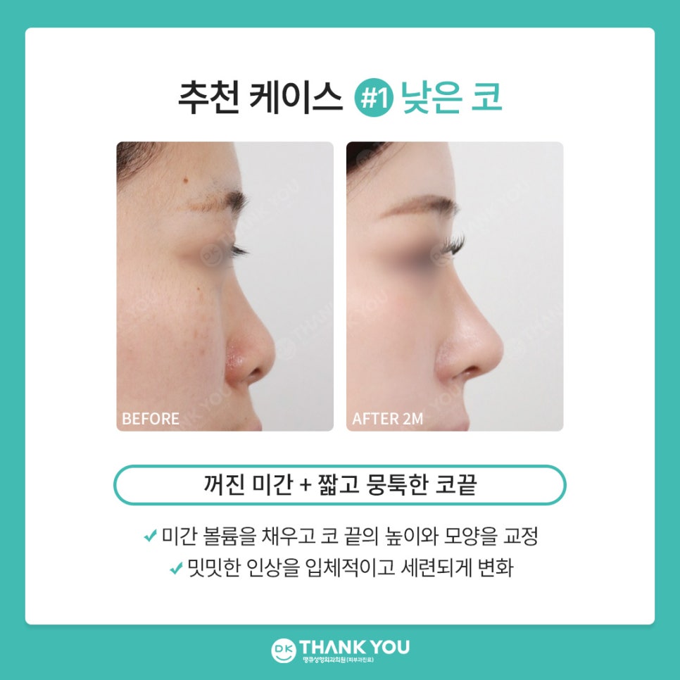 땡큐성형외과 권정우 원장, 코수술재료 관련 이미지 6