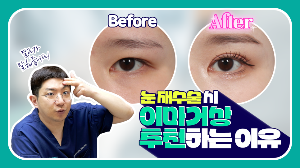 눈재수술 할 때 이마거상 추천하는 이유는? (눈썹올림술 전후) 관련 이미지 1