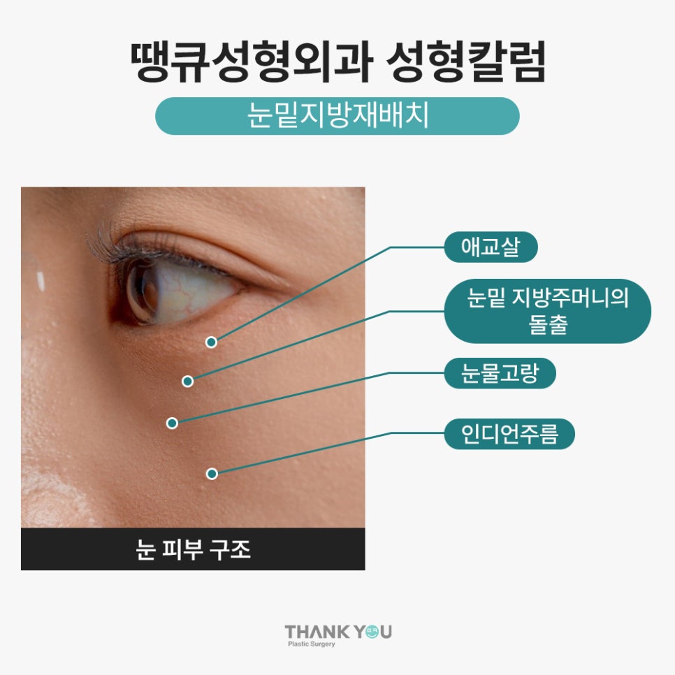 눈밑지방재배치 수술로도 볼륨이 부족한 경우엔? (ft. 앞광대 지방이식) 관련 이미지 3