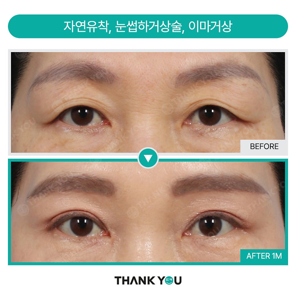 쌍꺼풀수술 없이 처진 눈 해결? [중년 이마거상/ 눈썹하거상술] 관련 이미지 8