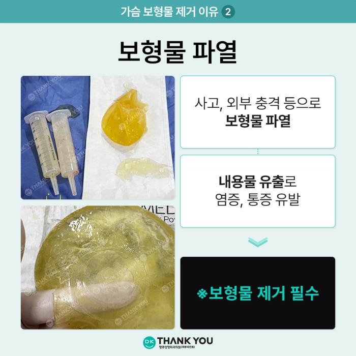 가슴보형물제거, 어떤 경우에 시행될까? 관련 이미지 3