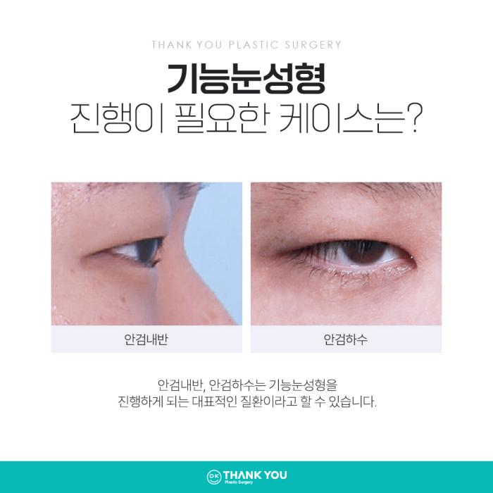 기능눈성형 근본적인 원인을 개선해야 해요! 관련 이미지 3