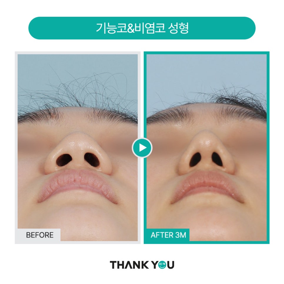2분만에 막힌 코 뻥 뚫어주는 코블레이션 [ft.비염코성형 전후] 관련 이미지 19