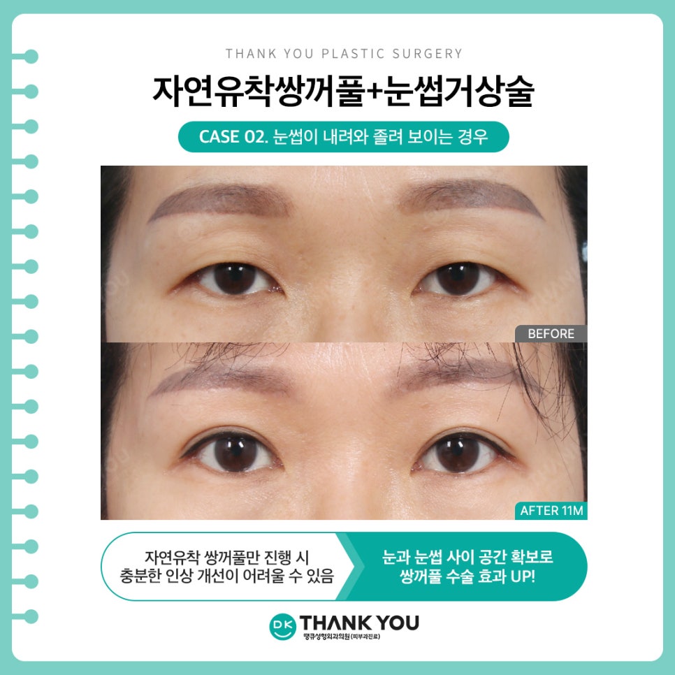 자연유착쌍커풀 + 눈썹하거상술, 자연스러운 라인에 처진 눈 개선까지?! 관련 이미지 5