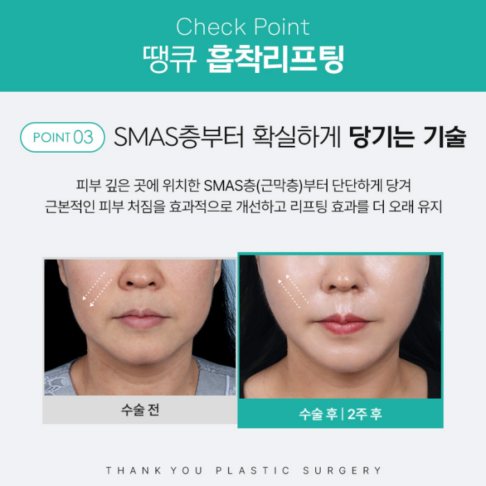 땡큐성형외과 이벤트 : 얼굴윤곽라인 개선엔?! 흡착리프팅 관련 이미지 7