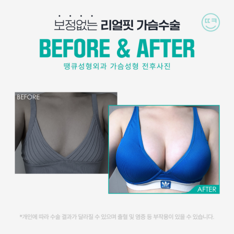 가슴수술잘하는곳 찾는 법?! 땡큐에서 알아보세요 관련 이미지 7