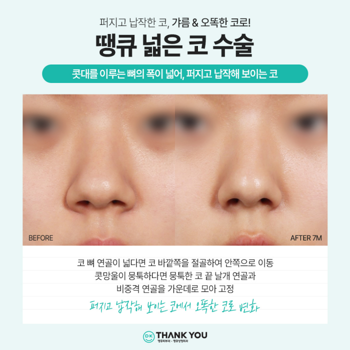 강남코성형 성공 방법은?! 코성형잘하는병원과 함께! 관련 이미지 5