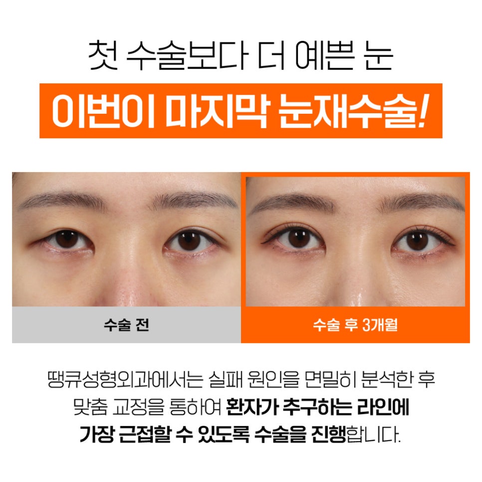 강남 눈재수술, THANK YOU기존 쌍꺼풀라인 풀기 관련 이미지 2