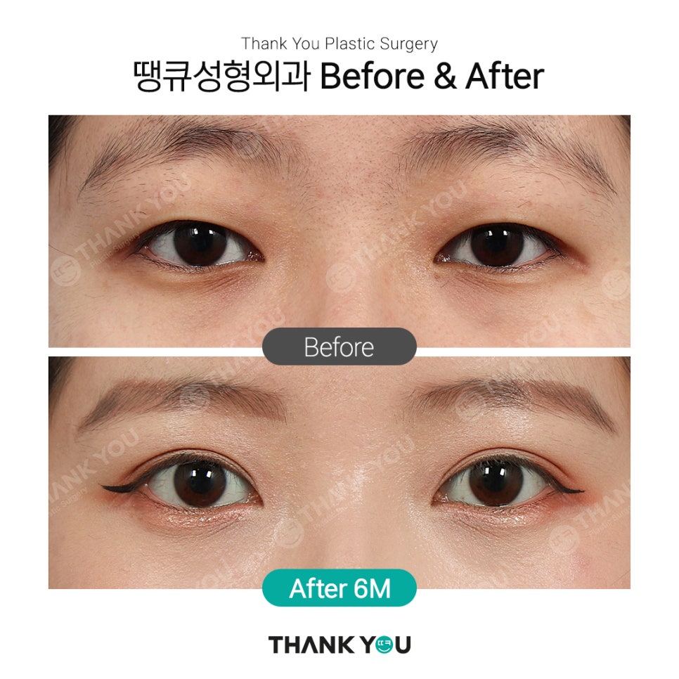 쌍꺼풀 라인 종류, 인아웃+세미아웃라인 Before After 관련 이미지 3