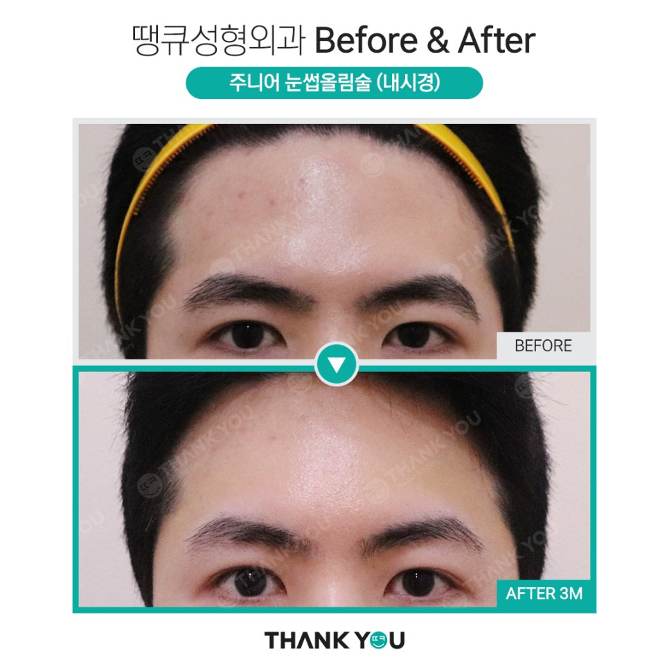 나이가 어린데도 이마거상을 꼭 해야 할까요? 관련 이미지 3