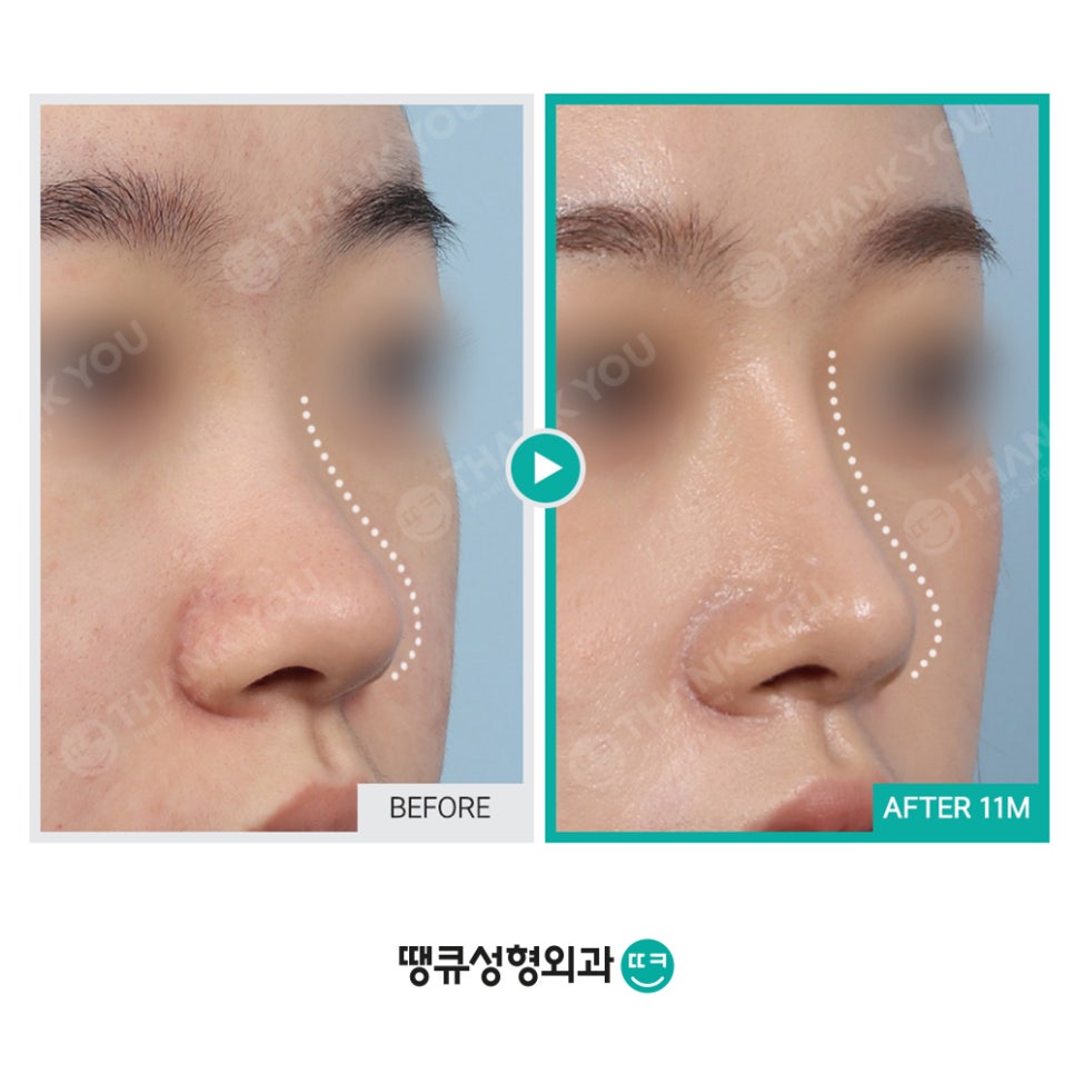 숨이 잘 안쉬어져요 실비코성형 비염도 기능코로 라인 커버! 관련 이미지 2