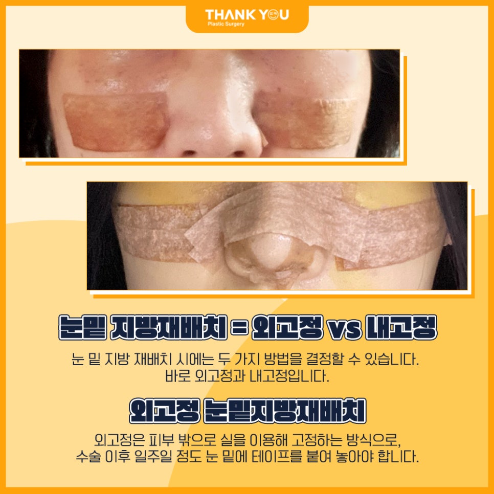 땡큐성형외과 이호준 원장님, 눈밑지방재배치 외고정vs내고정 차이점 관련 이미지 6