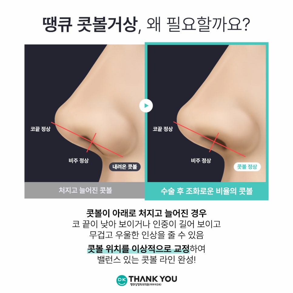 콧볼성형 찾는다면 여기! 땡큐 콧볼축소로 세련된 이미지 완성하기! 관련 이미지 8