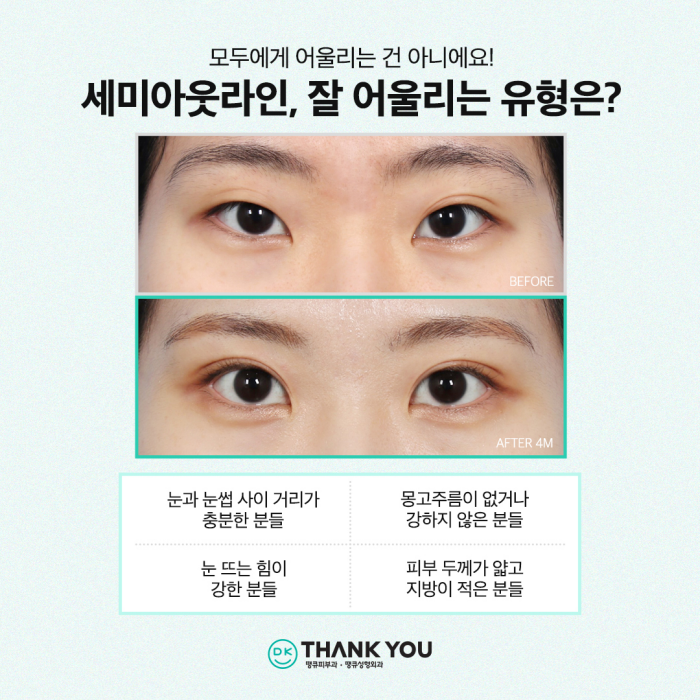 쌍수잘하는곳에서 세미아웃라인쌍꺼풀로 예쁜 눈 변신! 관련 이미지 4