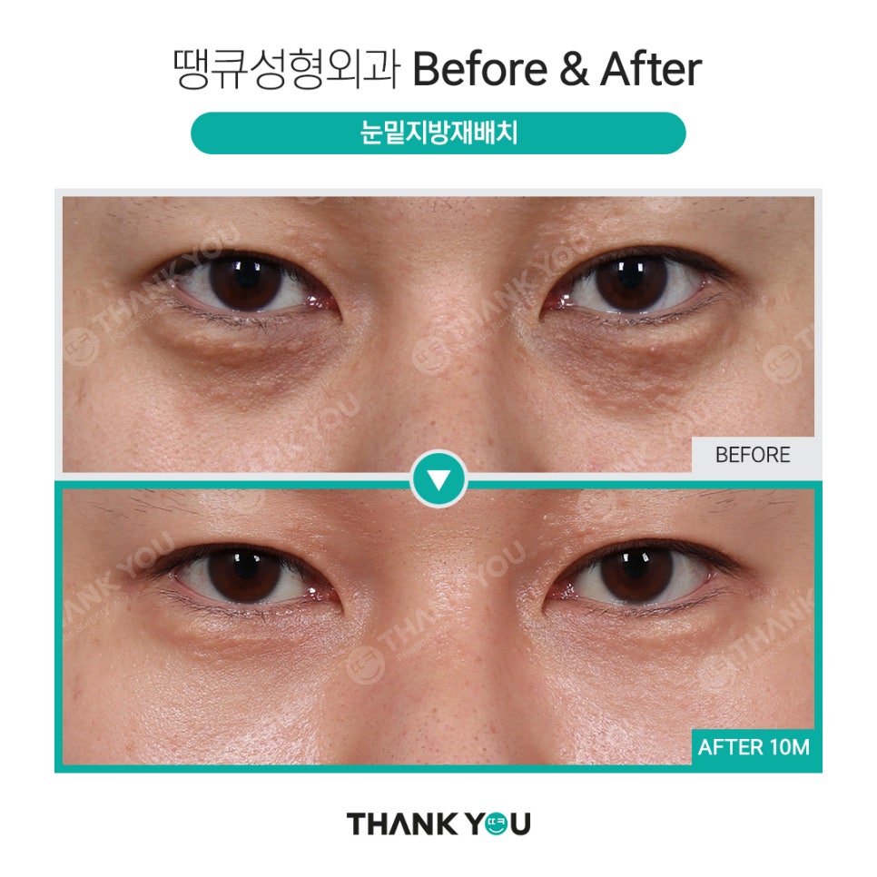 붐 눈밑지방재배치? 남자 눈밑지 전후 (붐, 남창희, 김동현) 관련 이미지 2