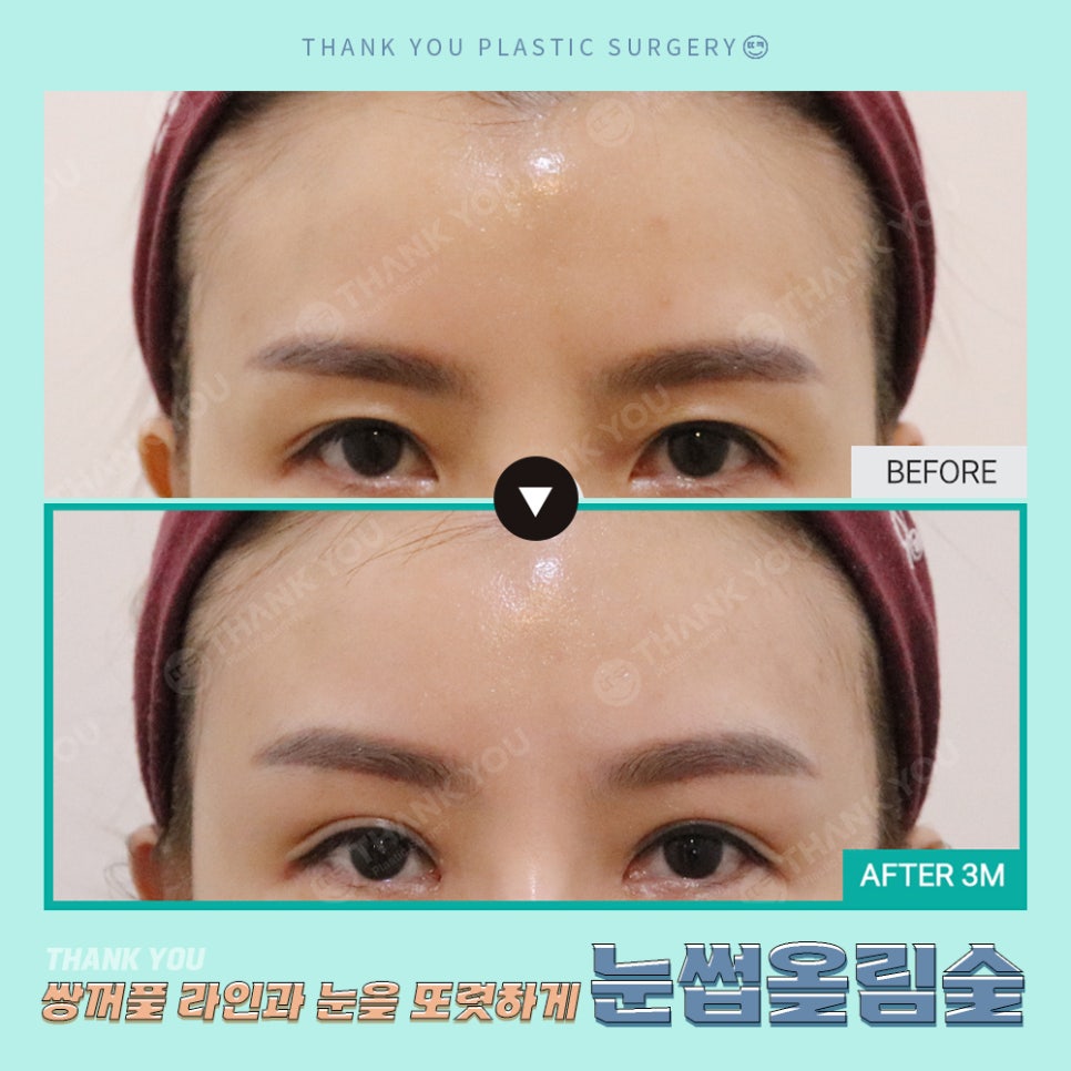 쌍수에 눈썹올림술을 추천하는 이유?! 관련 이미지 23