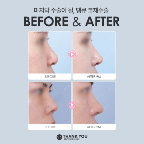 코재수술잘하는병원 땡큐 이벤트✨ 관련 이미지 13