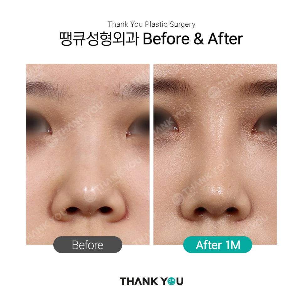 남자코성형 여자코성형 디자인 차이점 (코성형 전후) 관련 이미지 9