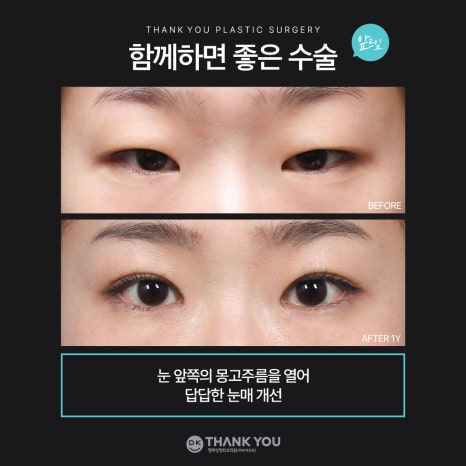 눈매교정잘하는곳 땡큐에서 더 또렷하게, 더 자연스럽게! 관련 이미지 6