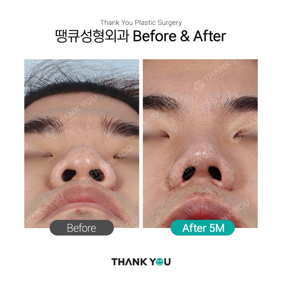 남자코성형 여자코성형 디자인 차이점 (코성형 전후) 관련 이미지 2