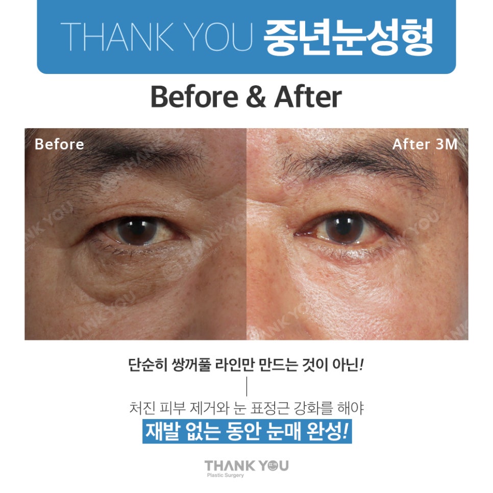 중년눈수술, 50대 60대 눈처짐과 눈꺼풀짓무름 해결법 관련 이미지 10