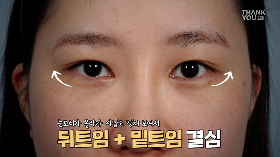 눈과 눈썹 사이 간격 넓히는방법? 이마거상술(눈썹올림술)로 시원하게 관련 이미지 9