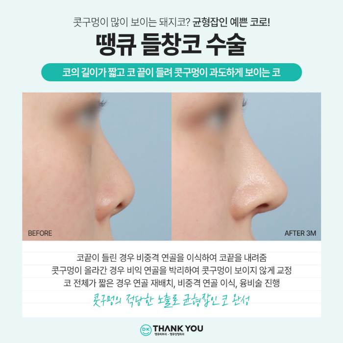 강남코성형 성공 방법은?! 코성형잘하는병원과 함께! 관련 이미지 6