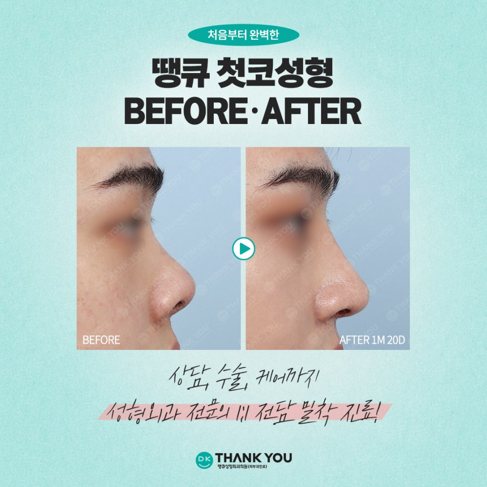 Key Checkpoints You Must Review When Considering Primary Rhinoplasty?! image 7