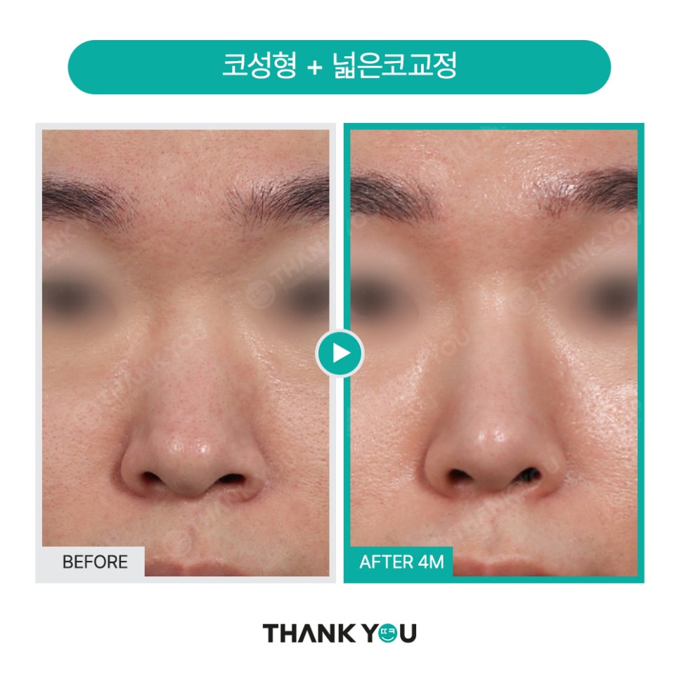 남자코성형 (휜코, 매부리코 등) 기능코성형 필요! [ft.코수술전후] 관련 이미지 8