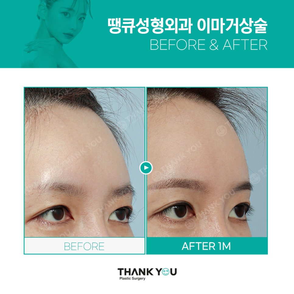 20대 30대를 위한 엔도타인 눈썹올림술(이마거상) 이란? 관련 이미지 8
