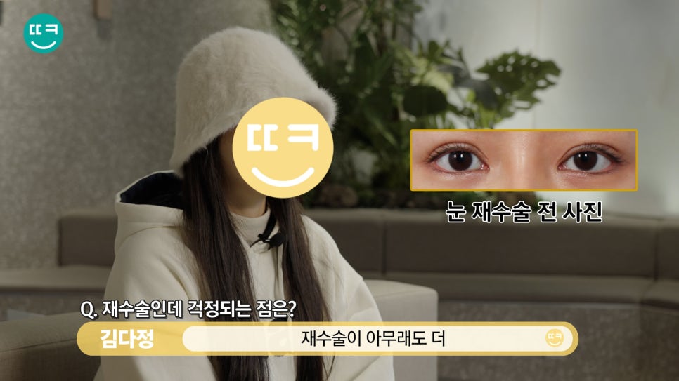 짝눈 쌍수 재수술, 짝짝이 라인과 비대칭쌍꺼풀 대칭 맞추기 관련 이미지 9