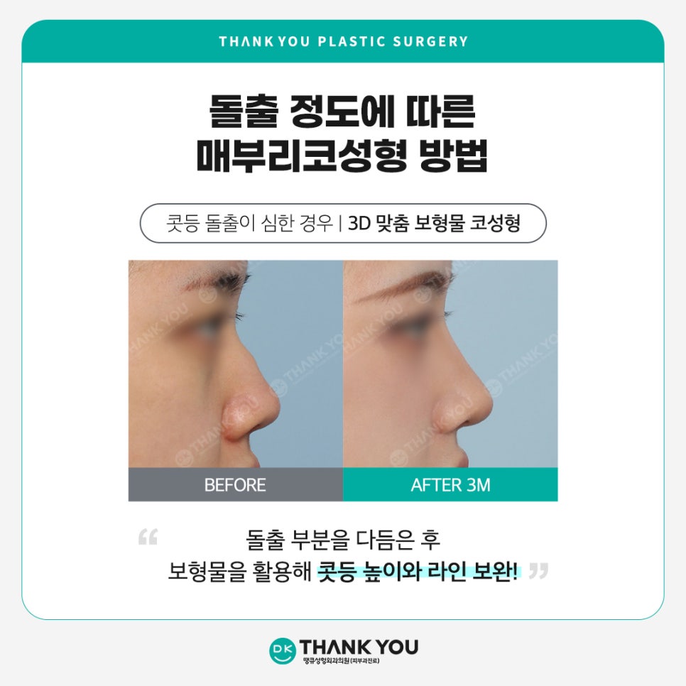 매부리코개선, 돌출 정도에 따른 맞춤 수술이 중요! 관련 이미지 6