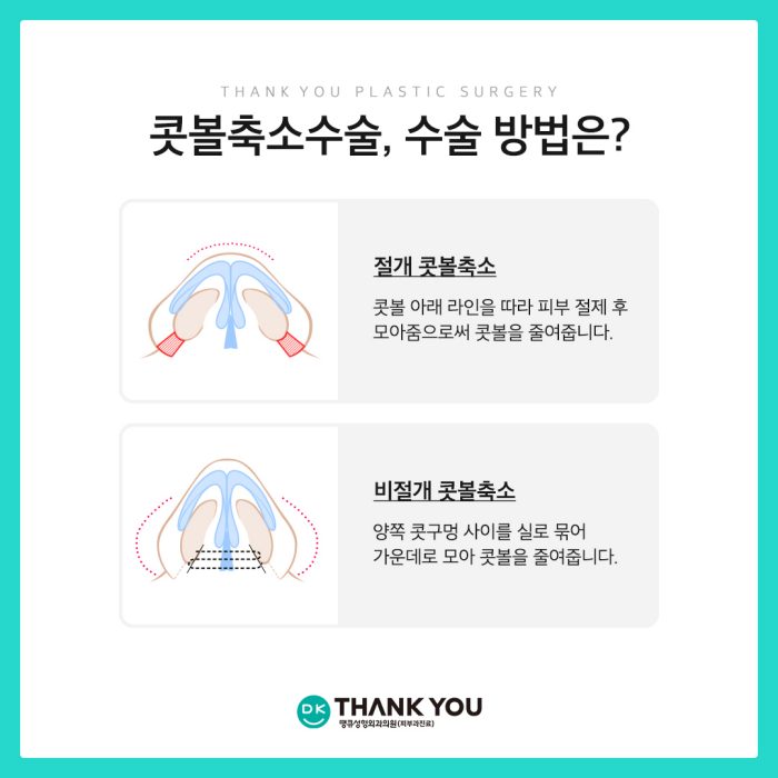 콧볼축소술효과로 세련된 이미지로의 변신 성공! 관련 이미지 3