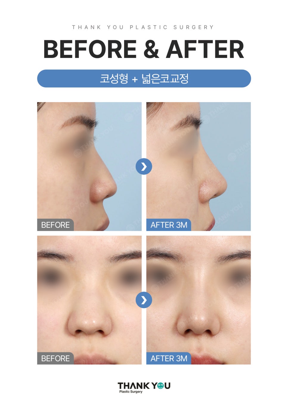 자가늑연골? 기증늑연골? 코성형수술 재료의 끝판왕? 관련 이미지 8