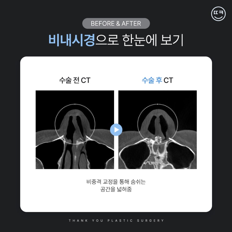 [맥미남 병원] 남자 휜코 성형, 막힌코수술, 코막힘 등 전후 까지 관련 이미지 13