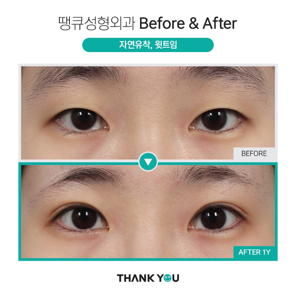 쌍수 윗트임 전후, 내게 맞춘 쌍트 수술로 화려하게 관련 이미지 5