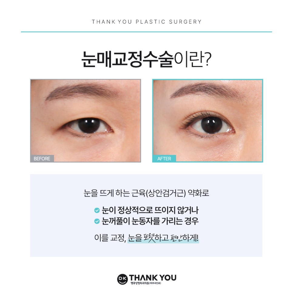 눈매교정잘하는곳 땡큐에서 더 또렷하게, 더 자연스럽게! 관련 이미지 3