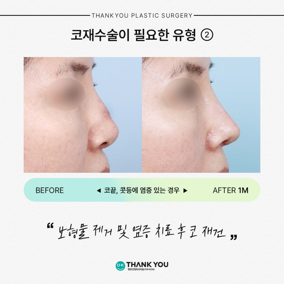 코재수술잘하는곳 땡큐가 제안하는 유형별 수술 방법은? 관련 이미지 4