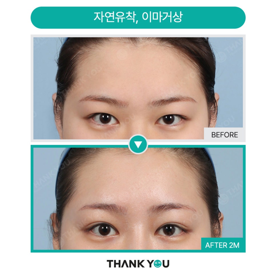 쌍꺼풀 풀림 쌍수 라인 풀림 증상? 이마거상수술로 개선! 관련 이미지 20