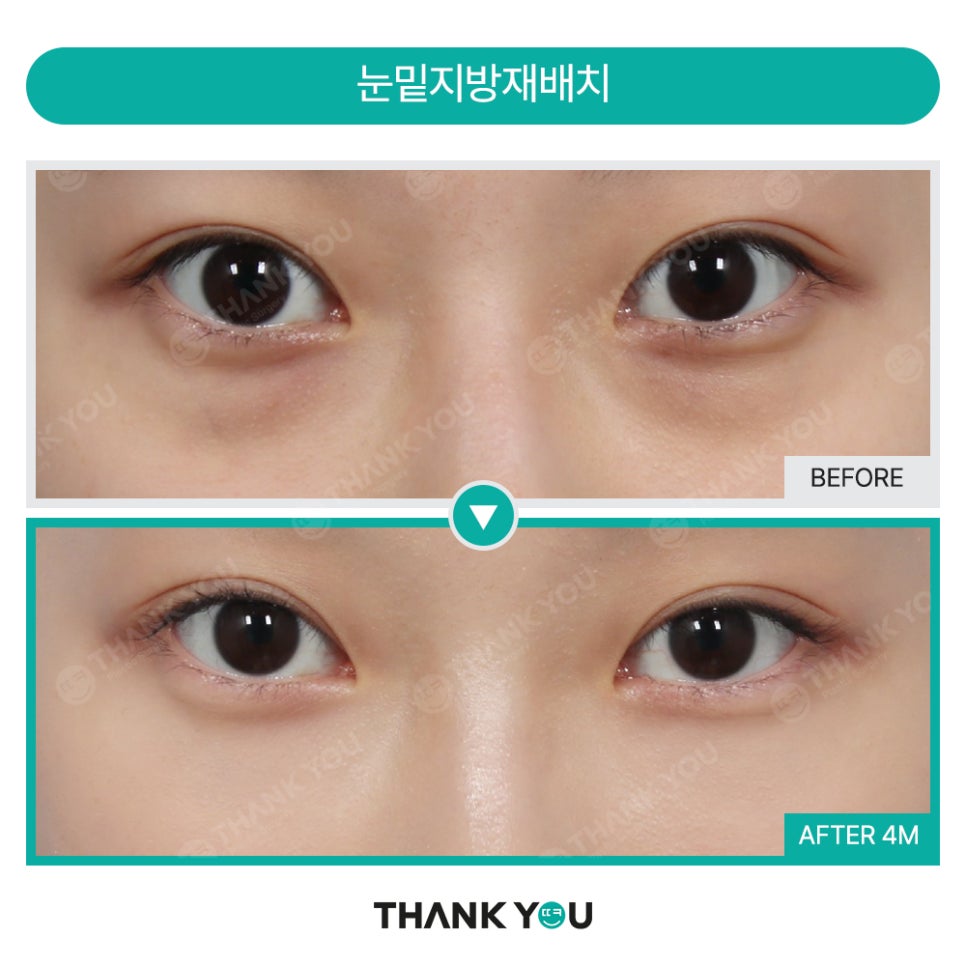 눈밑 수술, 혈류 보존이란? 관련 이미지 12