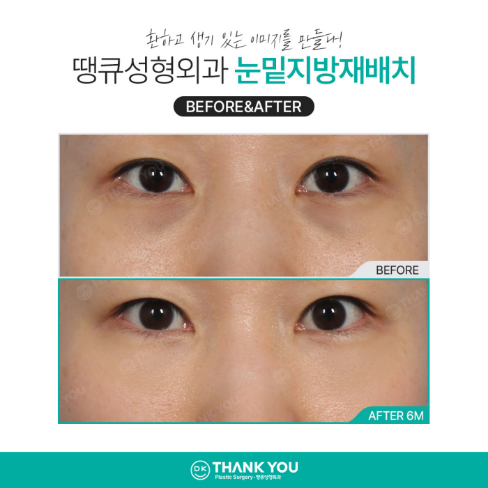 눈밑지방재배치병원에서 알려주는 수술이 필요한 케이스 관련 이미지 10
