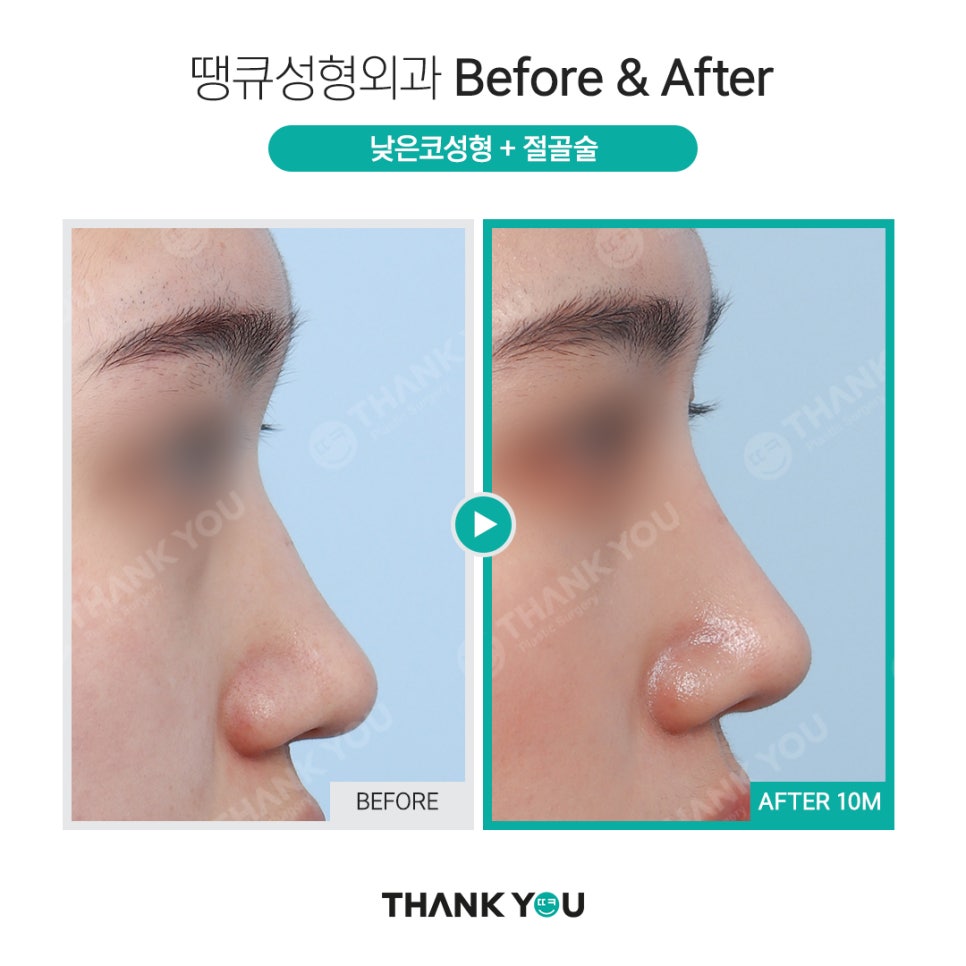 코 성형전, 코필러 꼭 제거해야 하나요? [코 수술전 필독!] 관련 이미지 6