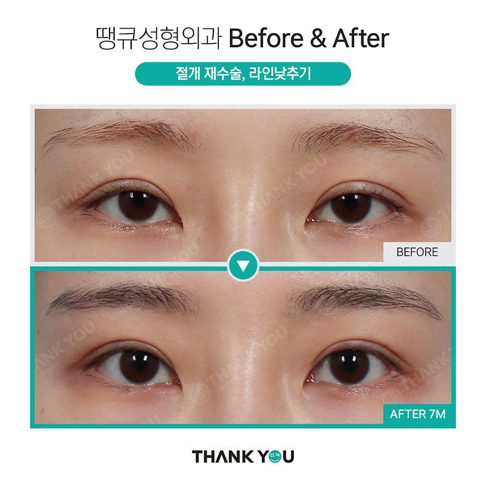 땡큐 절개쌍꺼풀 전후사진 (절개후 재수술 여부, NO?가능!) 관련 이미지 5