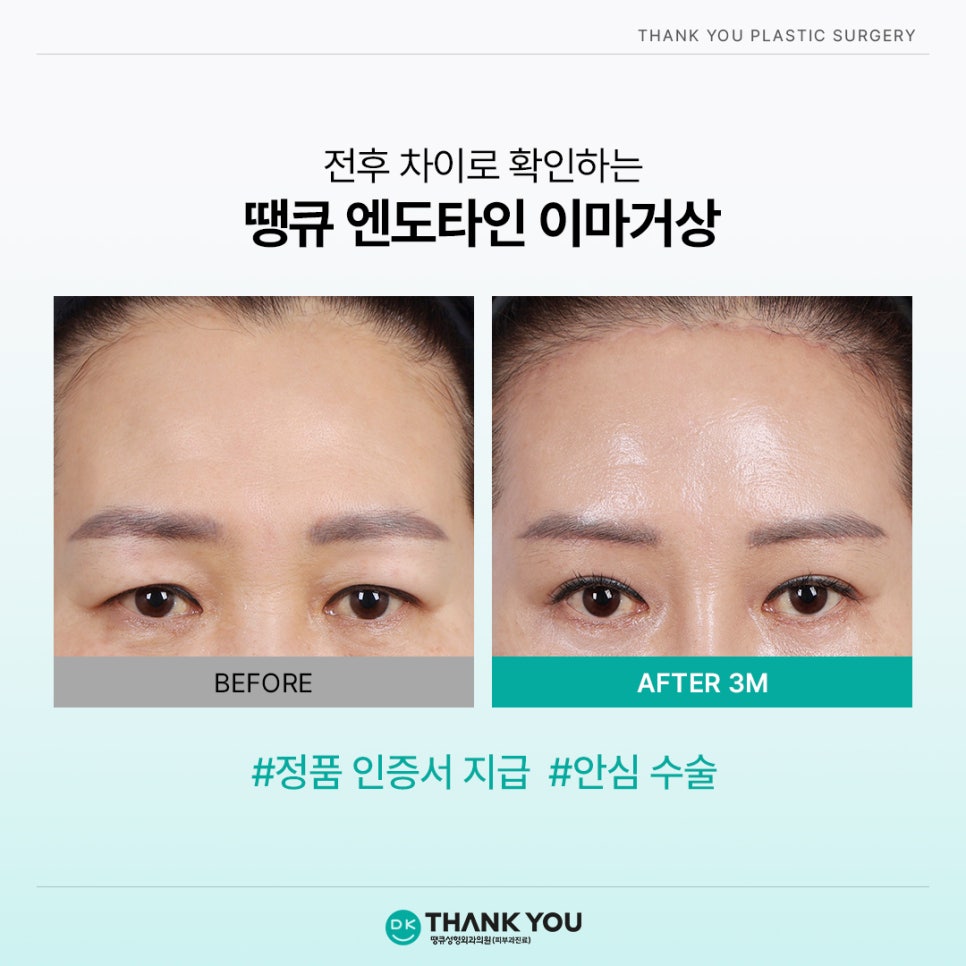 엔도타인 비용? 이마거상 시 정품 여부부터 체크!⭐️ 관련 이미지 7