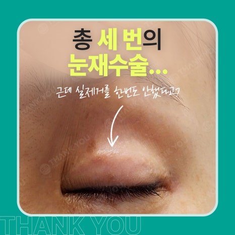 3번 눈재수술? 근데 실제거를 안했다고? 땡큐에서 전부 실제거! 관련 이미지 1