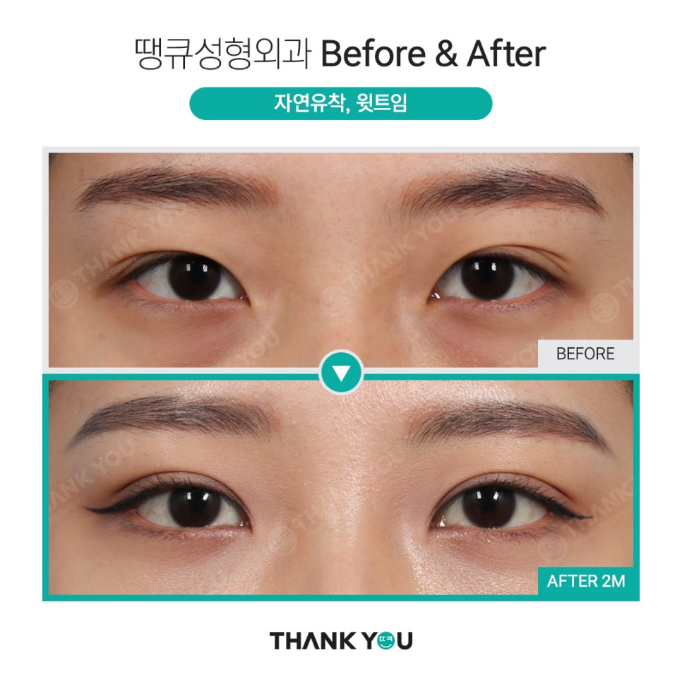 쌍수 뒷트임 (앞트임,밑트임, 듀얼트임 종류) 전후사진 관련 이미지 10